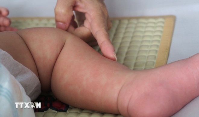 Bệnh sởi có triệu chứng gì và đối tượng nào dễ mắc phải?